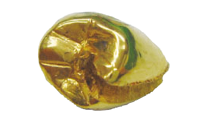 金歯